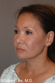 Fraxel Laser Rejuvenation