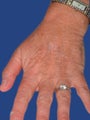 Hand Rejuvenation With Fraxel Dual Laser