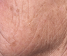 Fraxel
