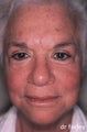 Fraxel Laser Treatment of Age Spots