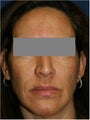 47 year old female treated for melasma, age spots, large pores and rough skin texture