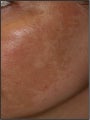 Fraxel - Melasma