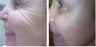 Fraxel Repair