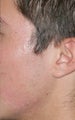 Fraxel Repair for Acne