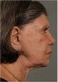 77 Year Old Female Treated for Wrinkles, Age Spots, and Skin Laxity non surgically