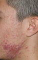 Fraxel Repair for Acne