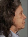 77 Year Old Female Treated for Wrinkles, Age Spots, and Skin Laxity non surgically