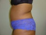40 year old lady with excess skin after gastric bypass - side view