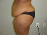 40 year old lady with excess skin after gastric bypass - side view