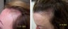 Female medical treatment for hair loss (no surgery)