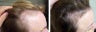Female medical treatment for hair loss (no surgery)