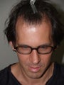 Hair Grafts