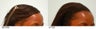 Female Hair Transplant