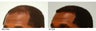 Hair Transplant