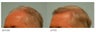 Hair Transplant