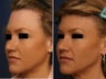 Hairline lowering