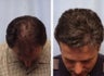 Hair replacement with Fleming/Mayer flap
