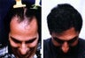 Hair replacement with Fleming/Mayer flap