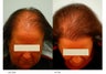 Female Hair Transplant