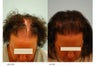 Female Hair Transplant