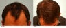 Hair Transplant