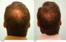 Hair Transplant