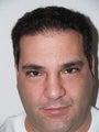 Hair Transplant- 2800 grafts