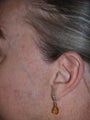 Reconstruction of sideburns with hair transplants lost as a result of prior facelift
