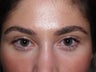 Eyebrow transplant