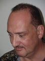 Hair Transplant - 3400 grafts