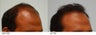 Hair Transplant