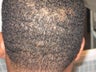 Hair Transplant - FUE 350 grafts