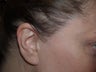 Hair Transplant / 850 grafts to temple