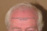 Neograft hair transplant no linear scalp scar!