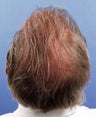 Hair Restoration
