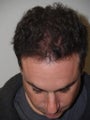 Hair Transplant