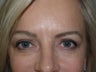 Eyebrow Transplantation