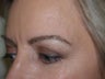 Eyebrow Transplantation