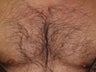 Chest Hair Transplant