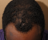 FUE Neograft hair transplant African American