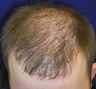 Hair Transplant