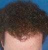 Hair Transplant
