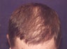 Hair Transplant