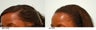 Female Hair Transplant