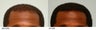 Hair Transplant