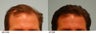 Hair Transplant