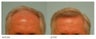 Hair Transplant