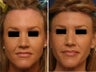 Hairline lowering