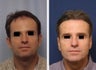 Hair replacement with Fleming/Mayer flap