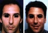 Hair replacement with Fleming/Mayer flap
